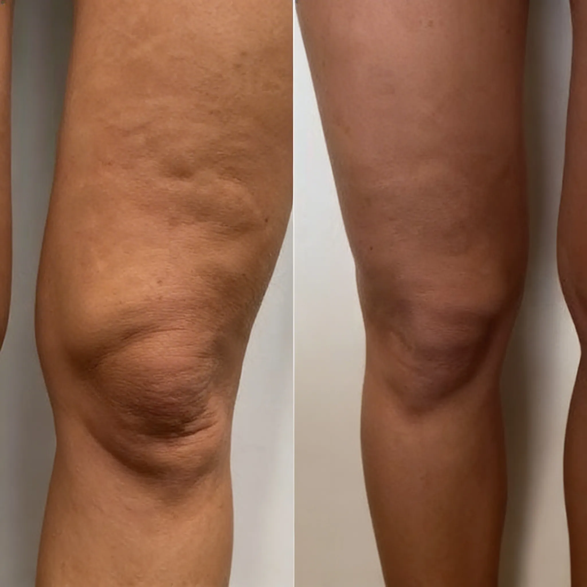 Antes e depois — Coxas e pernas